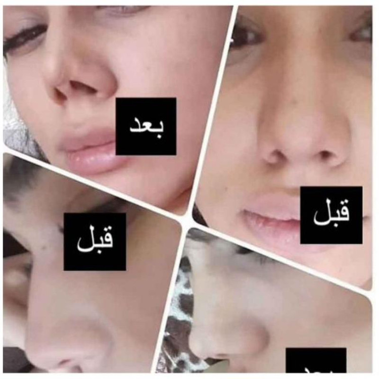 چسب لیفت و فرم دهنده بینی مدل بی رنگ (نامرئی)